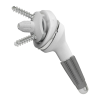Preview: SMR Axioma TT Metal Back Glenoid Bone Grafting
