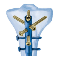 Preview: Synthes Expert Tibial Nail