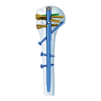 Preview: MultiLoc Proximal Humeral Nail